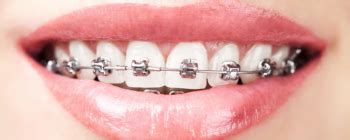 fastbraces reddit|Fastbraces Review: Treatment Time, Cost, and .
